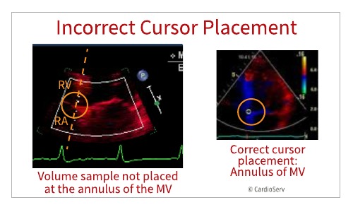 Common mistakes - Diastolic Dysfunction