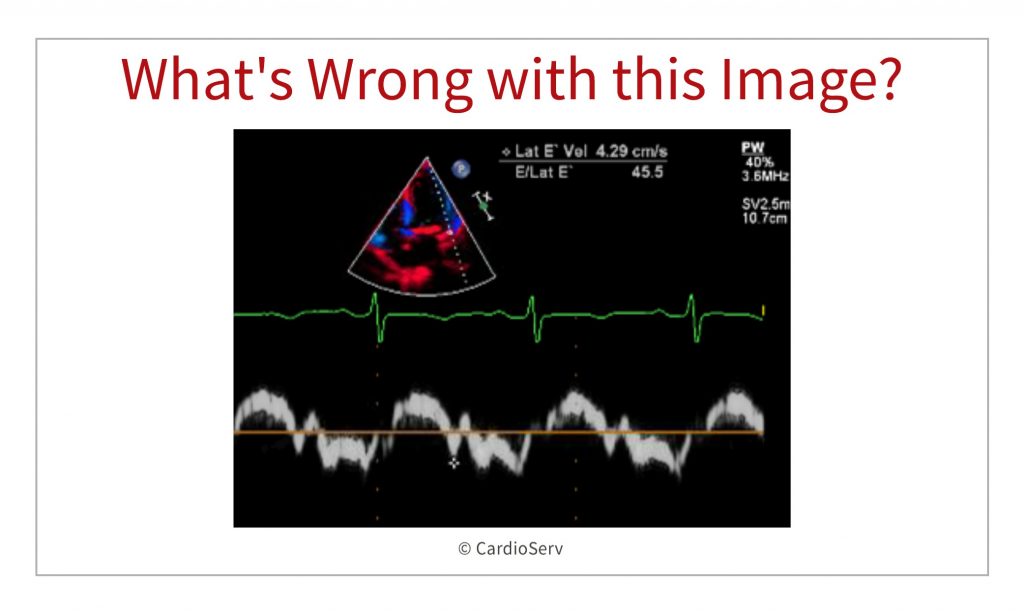 whats wrong with this image - tissue doppler echocardiograhy