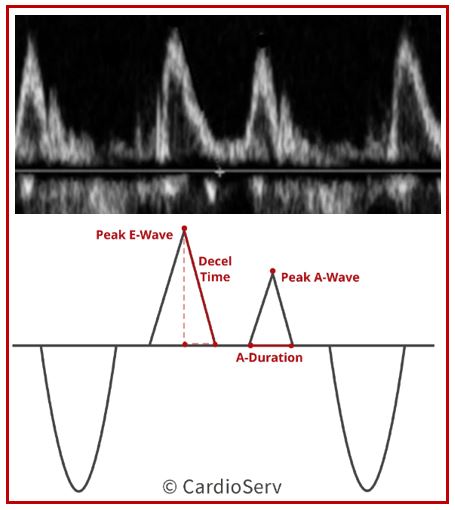 Common mistakes - Diastolic Dysfunction