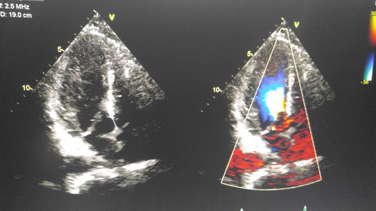 gerbode defect echocardiography