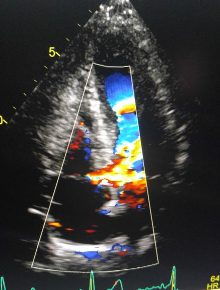 gerbode defect echo