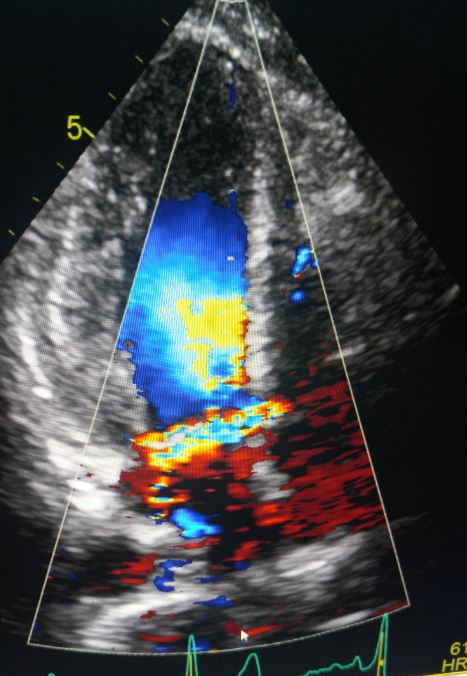 gerbode defect shunt echo