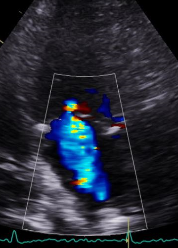 mitral regurgitation, secondary MR vena contracta