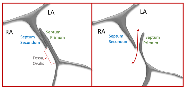 4 things to rule out Patent Foramen Ovale (PFO) - Interatrial septum anatomy