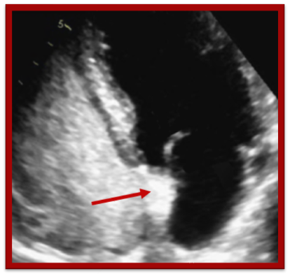 4 things to rule out Patent Foramen Ovale (PFO) - IAS shift right to left