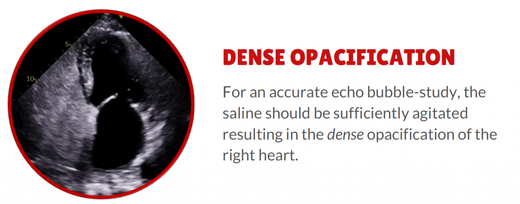 4 things to rule out Patent Foramen Ovale (PFO) - 1. Dense opacification