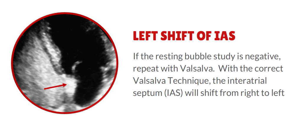 4 things to rule out Patent Foramen Ovale (PFO) - 2. Left shift of IAS