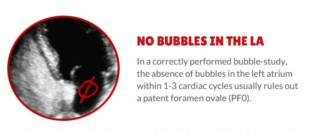 4 things to rule out Patent Foramen Ovale (PFO) - 3. No bubbles in the LA