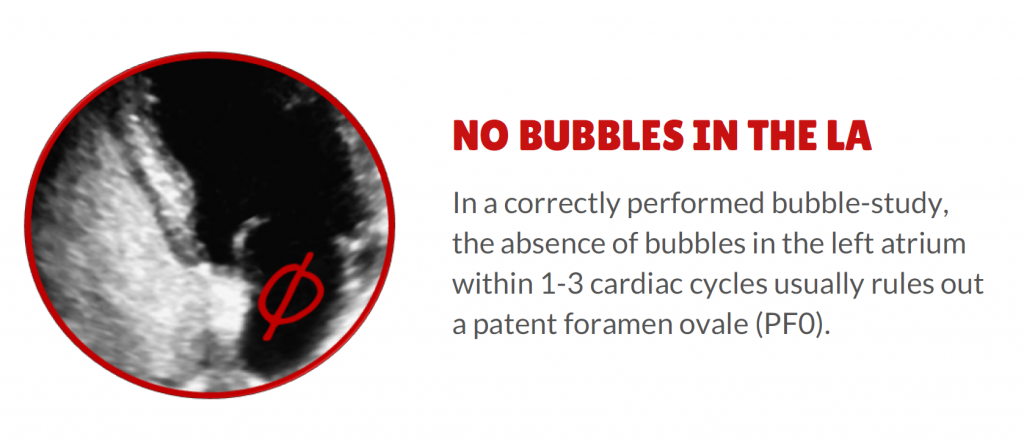 4 вещи, позволяющие исключить патентованное овальное отверстие (ПФО) - 3. Пузырьков в ЛЖ нет.