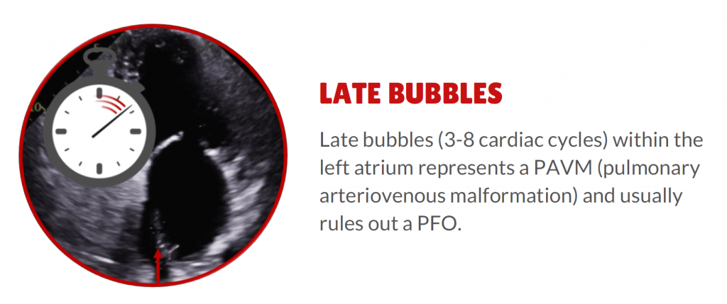 4 things to rule out Patent Foramen Ovale (PFO) - 4. late bubbles PAVM