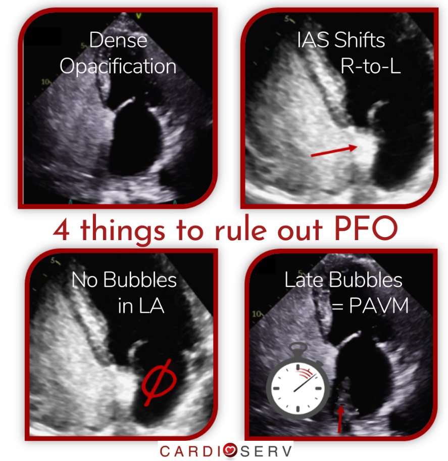 4 Things Needed To Rule Out a Patent Foramen Ovale (PFO)