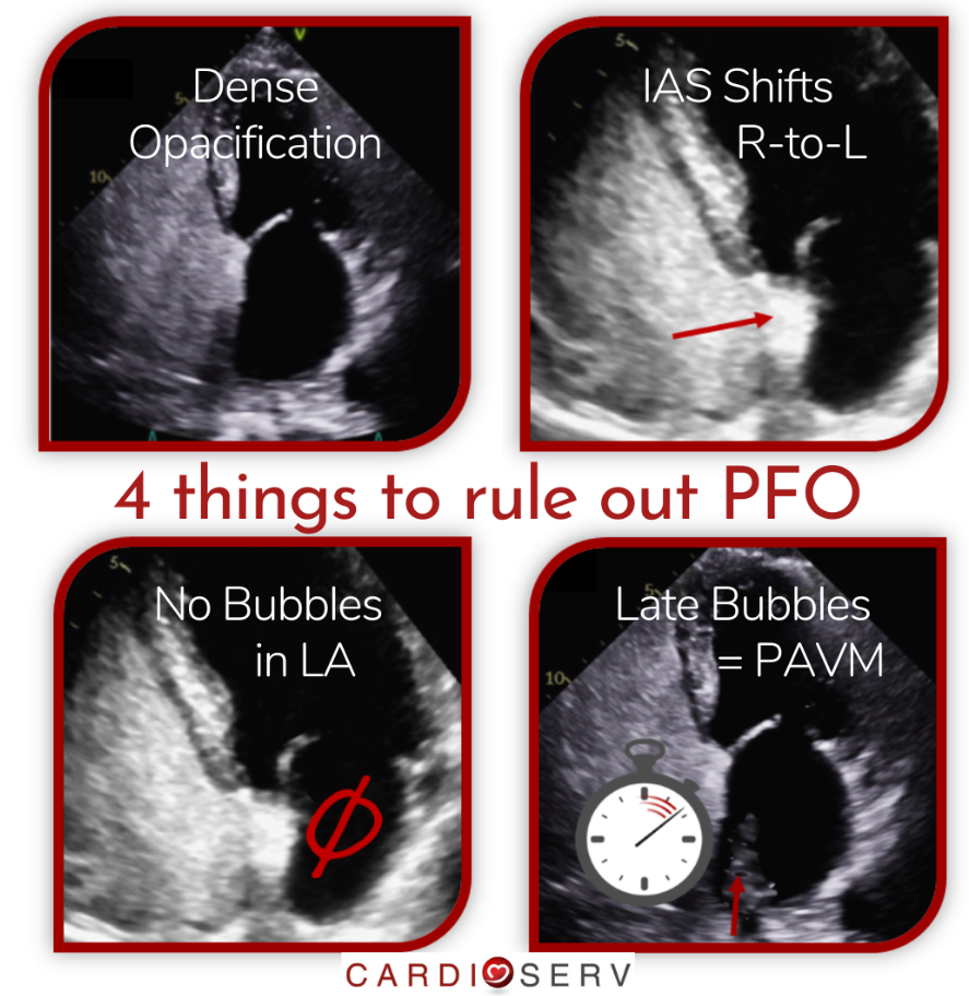 Patent Foramen Ovale (PFO): Symptoms, Causes & Treatment