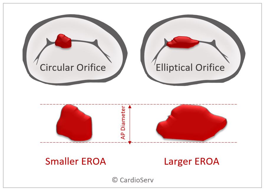 What I Wish You Knew about Secondary MR and Vena Contracta Width (VCW)!