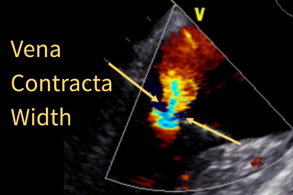 how to measure MR vena contracta width VCW echocardiography
