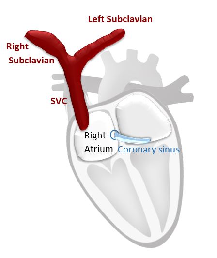 Normal SVC anatomy versus
PLSVC