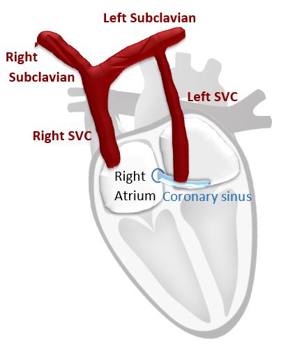 Persistent Left Superior Vena Cava PLSVC anatomy