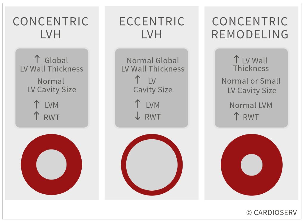 concentric vs eccentric left ventricular hypertrophy in echocardiography
