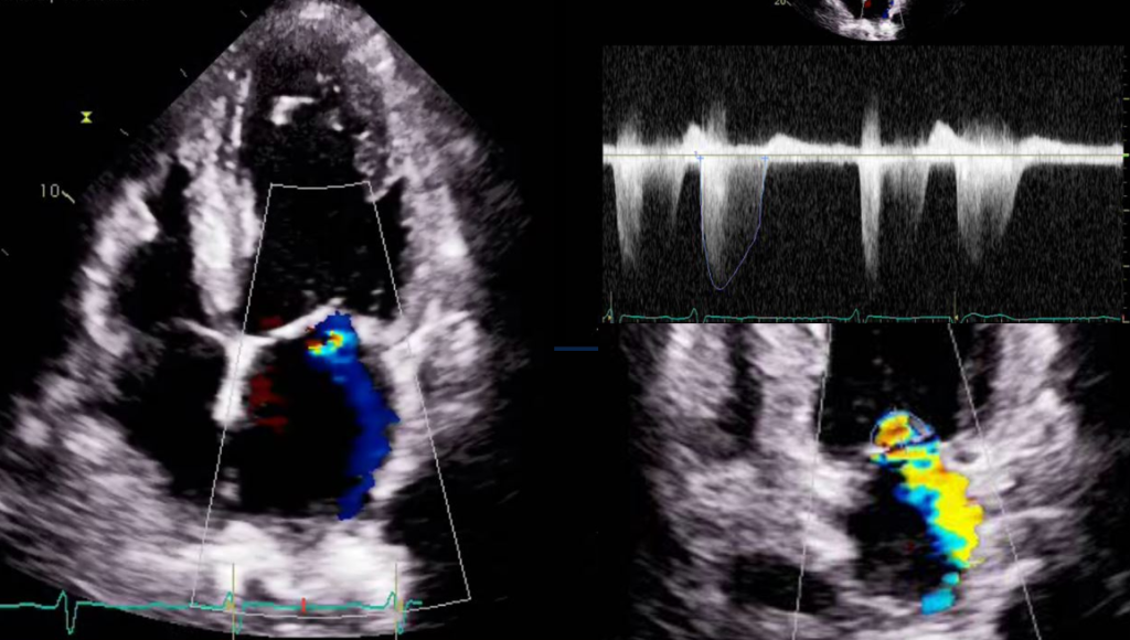online echo CME MR Quantification in Echo