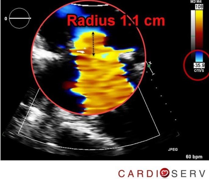 Color Doppler echocardiogram showing flow convergence with aliasing (red hemisphere)
