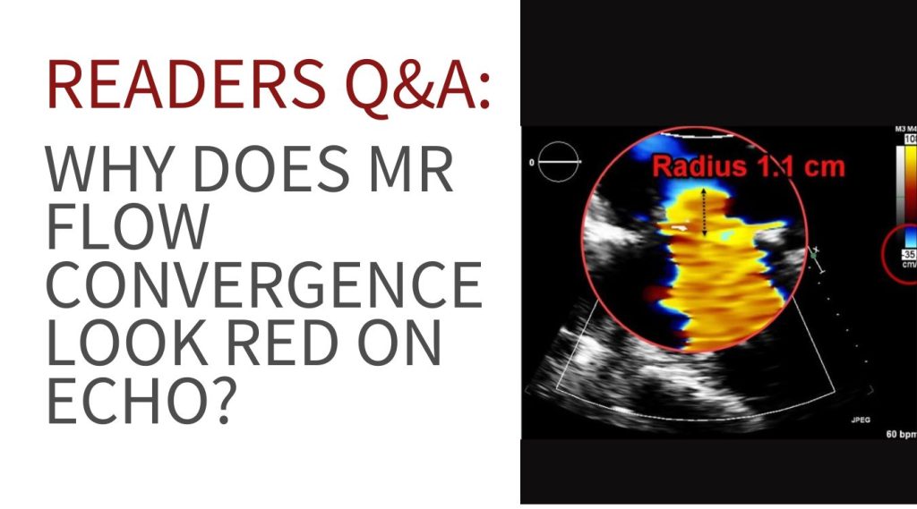 “Color Doppler echocardiogram showing flow convergence with aliasing (red hemisphere)