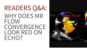 “Color Doppler echocardiogram showing flow convergence with aliasing (red hemisphere)