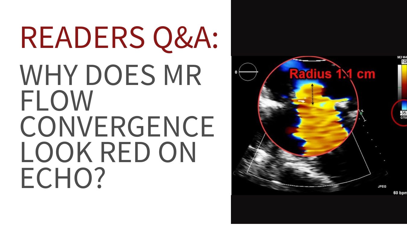“Color Doppler echocardiogram showing flow convergence with aliasing (red hemisphere)