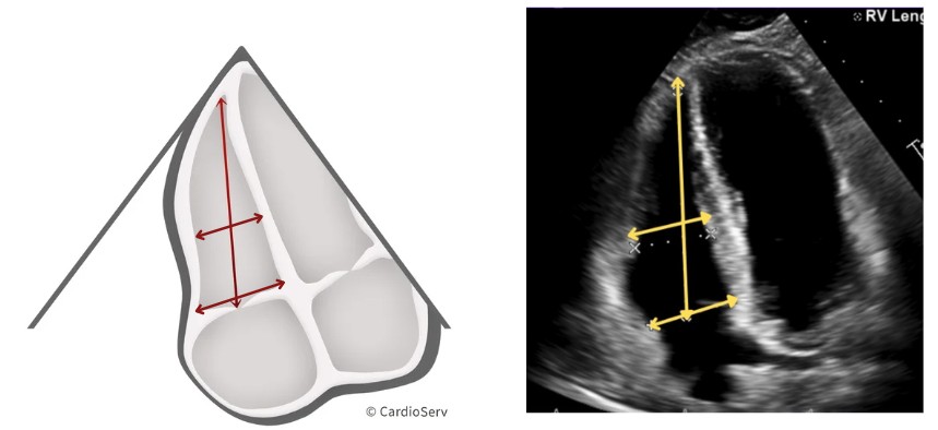 right ventricle linear measurements