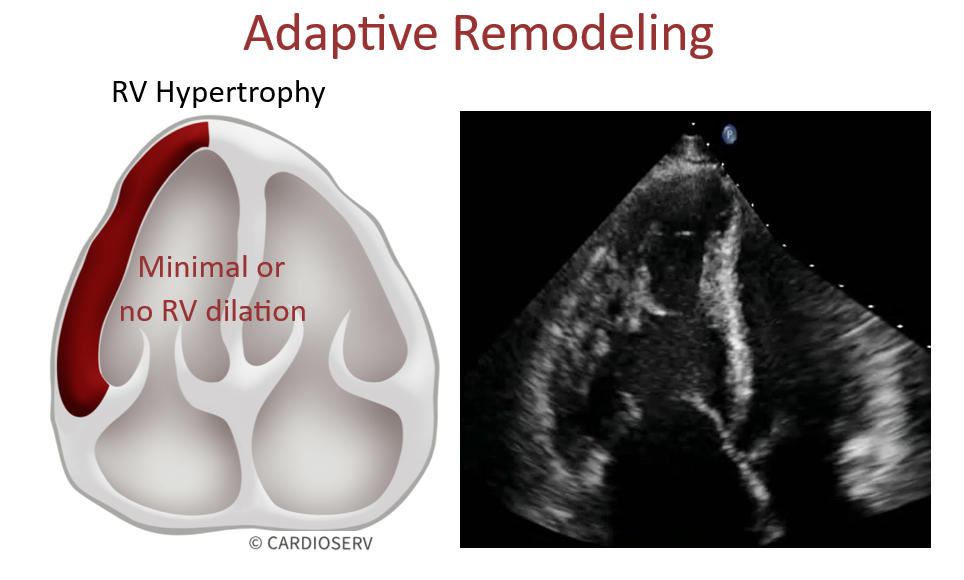 adaptive RV remodeling pulmonary hypertension echo