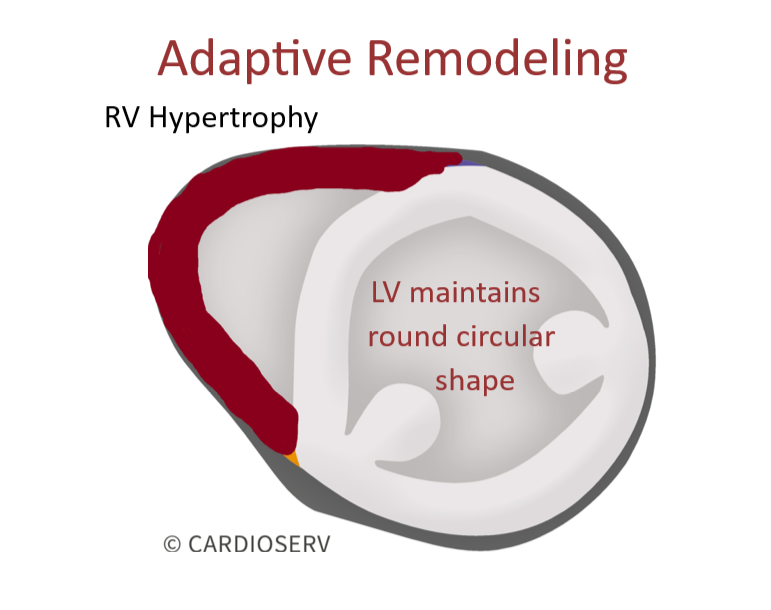 adaptive RV remodeling pulmonary hypertension echo
