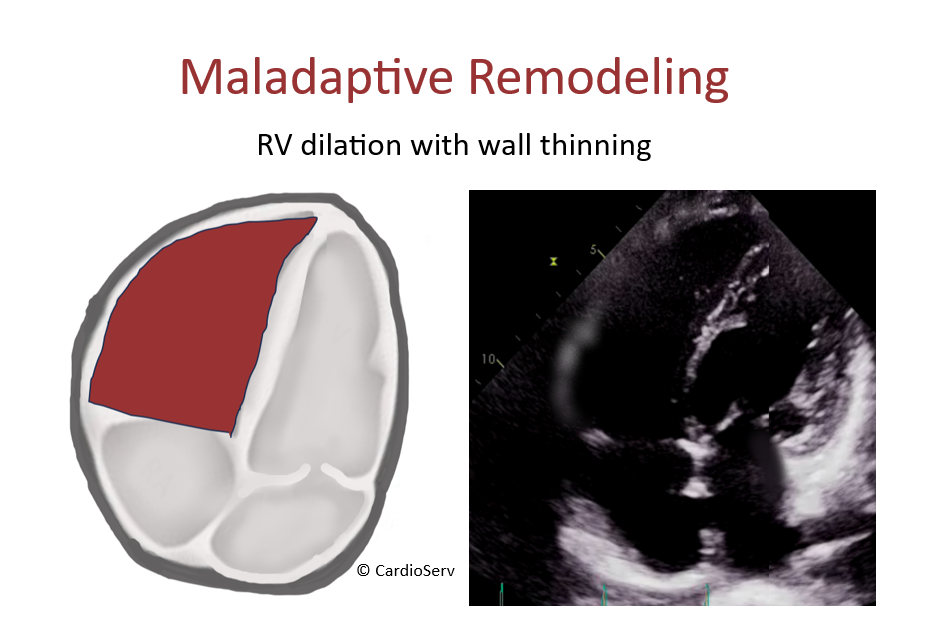 maladaptive remodeling pulmonary hypertension echo RV apical 
