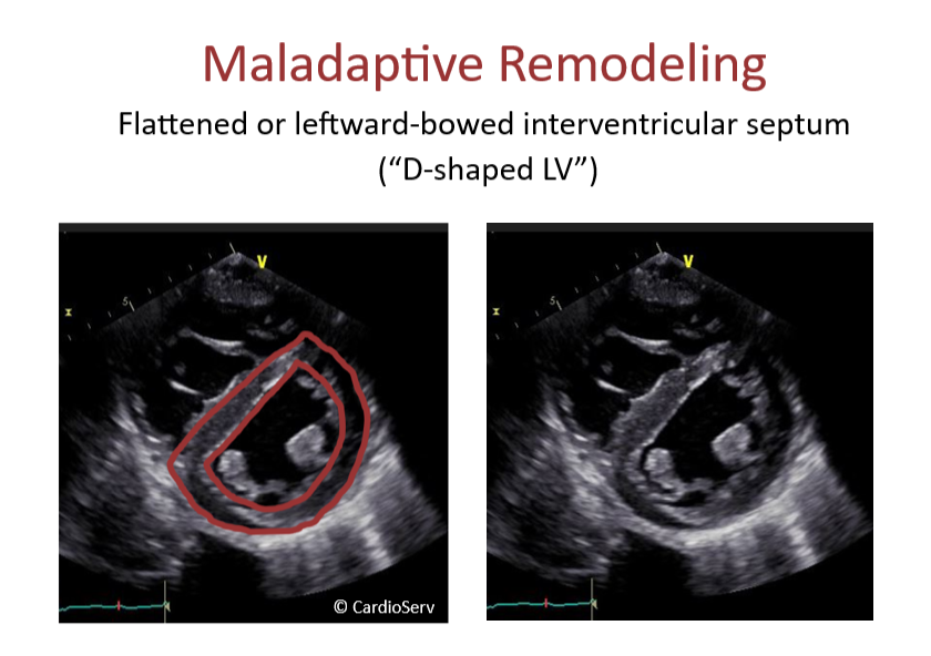 maladaptive remodeling pulmonary hypertension echo septal flattening psax