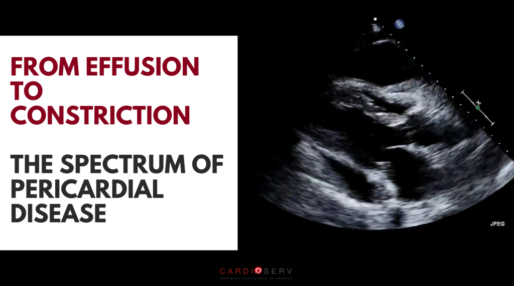 spectrum of pericardial disease