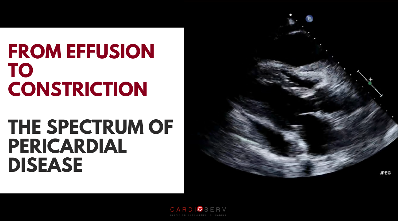 spectrum of pericardial disease