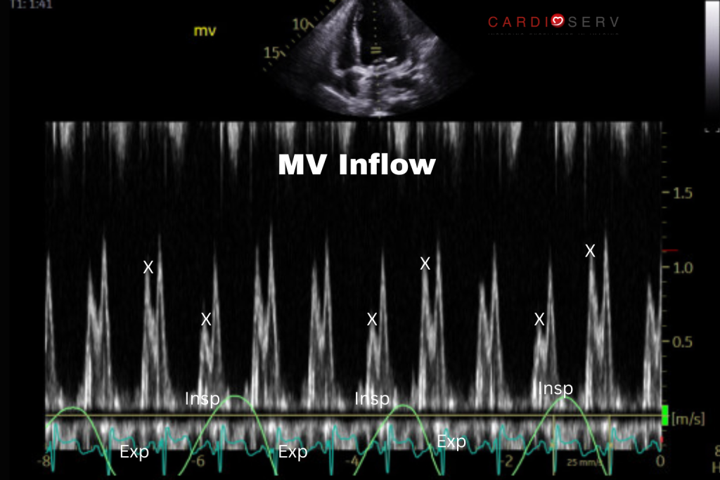 mv inflow variation tamponade