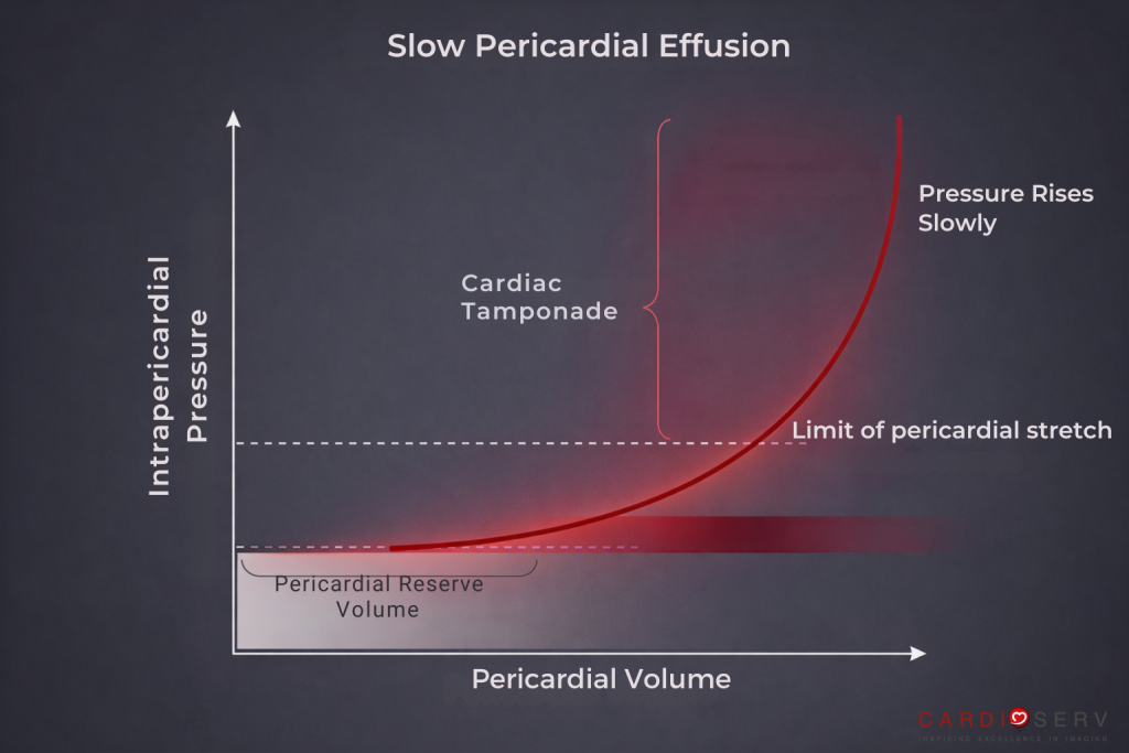 slow filling pericardial effusion pressure curve