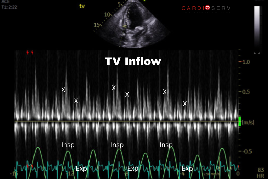 tv inflow variation tamponade