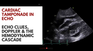 cardiac tamponade echo