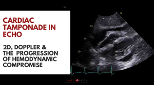 cardiac tamponade echo findings