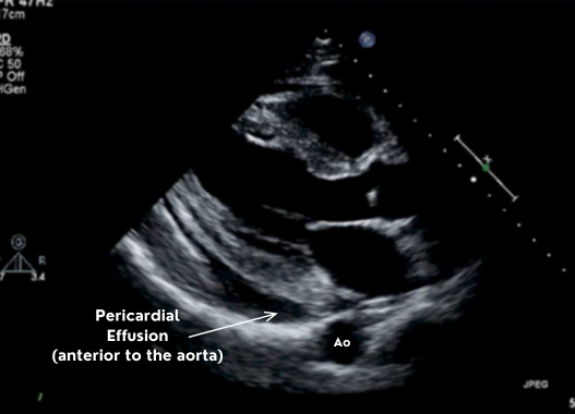 pericardial effusion on parasternal long axis plax 