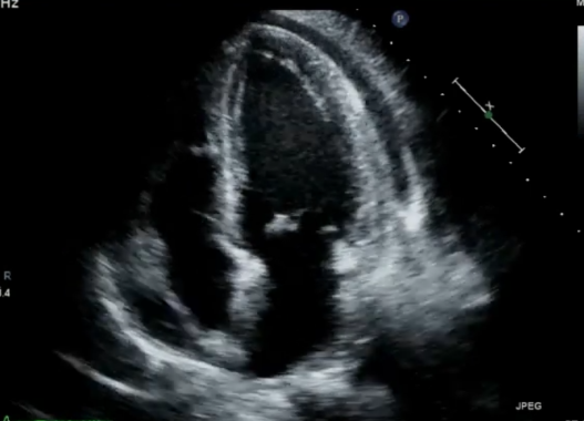 pericardial effusion apical 4 chamber