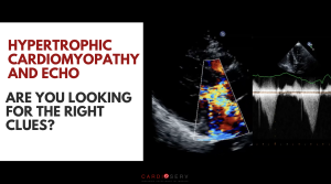 hcm on echocardiogram