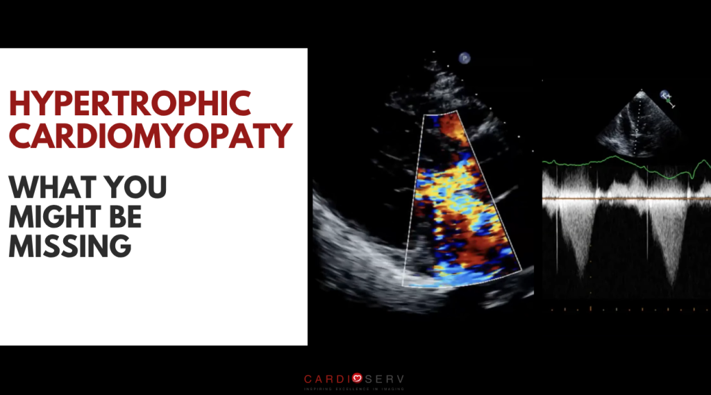 hypertrophic cardiomyopathy echocardiography