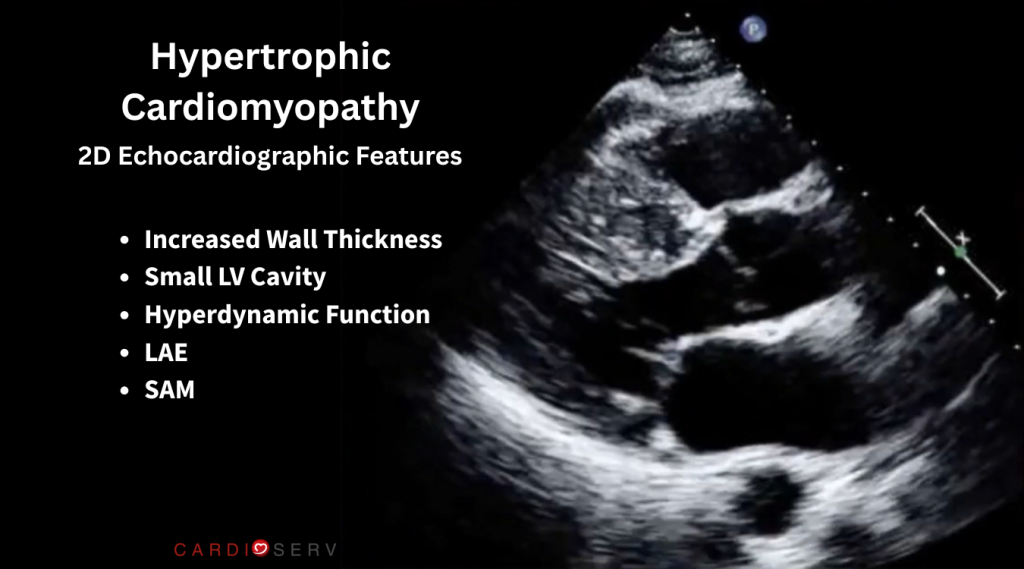 hypertrophic cardiomyopathy echo findings 2D