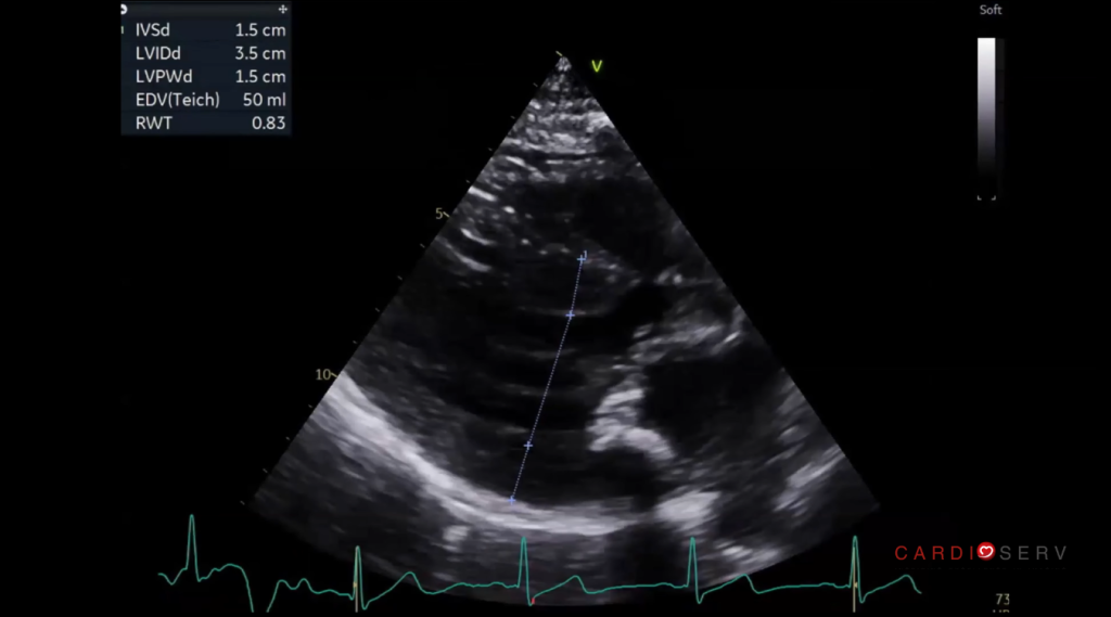 accurate wall thickness measurement hcm