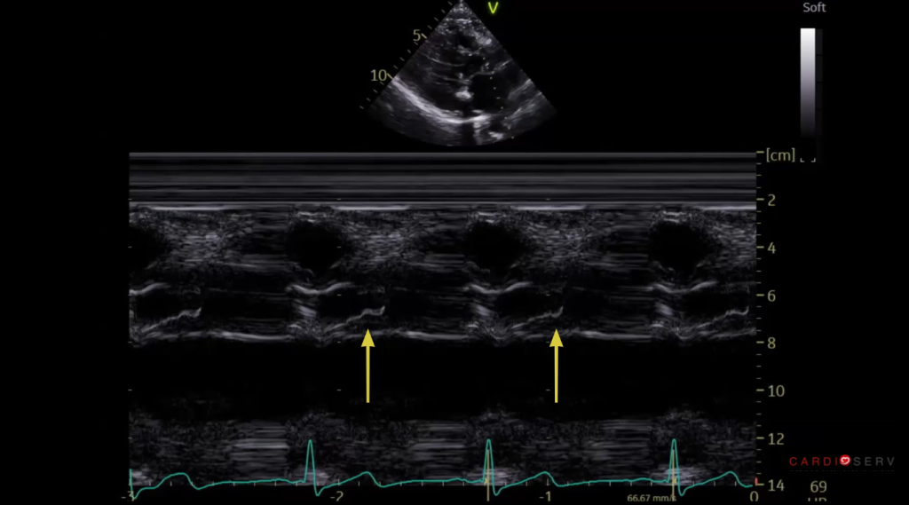 SAM on Aortic Valve M-mode