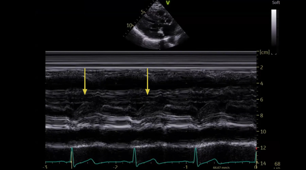 mmode sam mitral valve