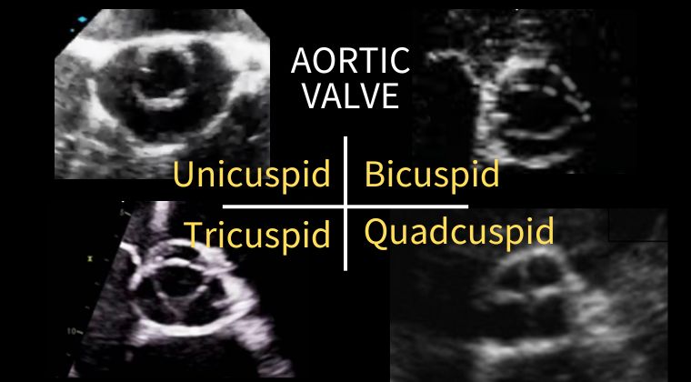 Aortic valve anatomy illustration with corresponding parasternal short-axis echocardiographic view