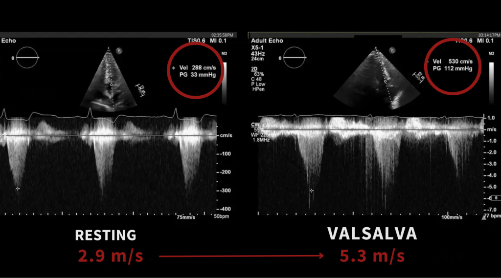 doppler change with valsalva in hypertrophic cardiomyopathy