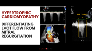 differentiate LVOT from MR Doppler in hcm
